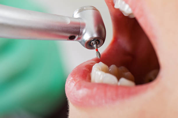 Best Emergency Root Canal Treatment in Masury, OH